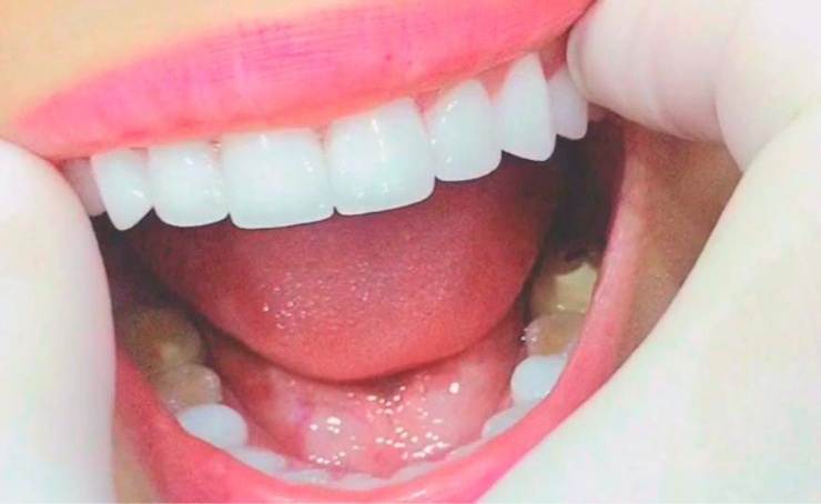 Kết quả bọc răng sứ thành công